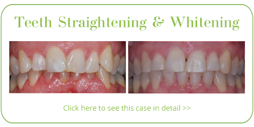 Teeth Straightening Skegness